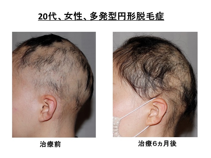 円形脱毛症　病院